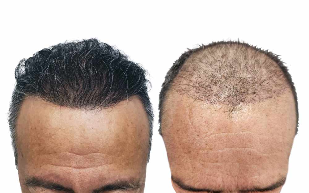 before & After alopecia androgenetic hair implant Dra Scallett Soto questions answers hair transplant