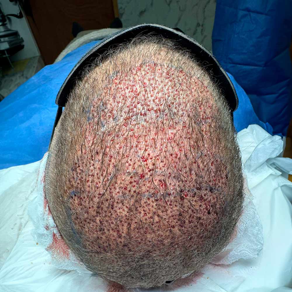 Cancun hair transplant dra scarlett